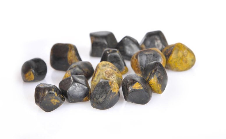 Gallstones