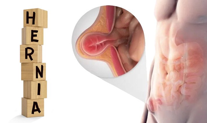 Do all groin hernias need surgical repair?