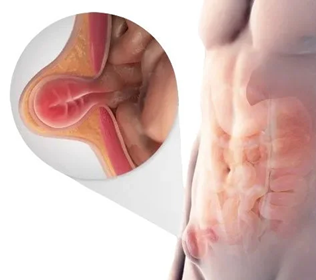 Illustration showing a hernia through the abdominal wall.